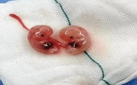 طريقة إسقاط الجنين قبل الأربعين بسبب الظروف النفسية والاجتماعية