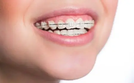 أسعار تقويم الأسنان في السعودية