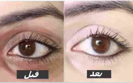 التخلص من الهالات السوداء