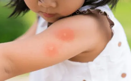 الفرق بين قرصة الناموس وقرصة البق