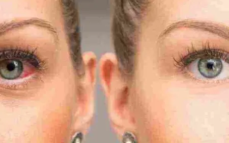 أفضل قطرة لعلاج ارتفاع ضغط العين