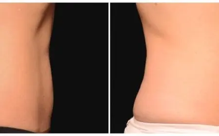 تجربتي مع حقن ميزوستاتيك