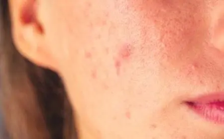 علاج الحبوب في الوجه للبشرة الدهنية بالطرق الطبيعية والطبية