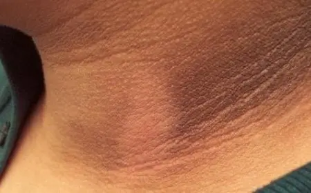 علاج سواد الرقبة طبيًا