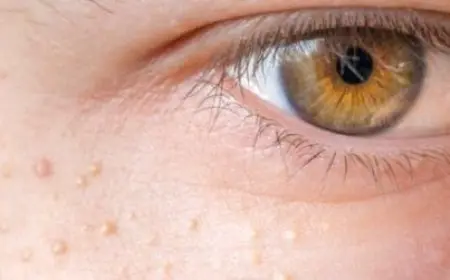 أنواع الحبوب تحت الجلد