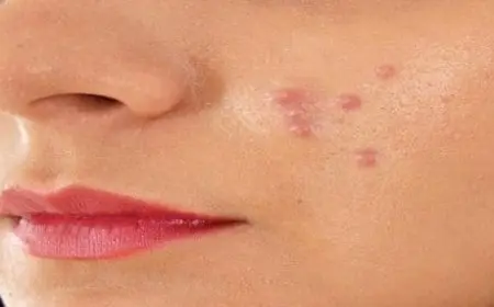 أنواع الحبوب الجلدية الخطيرة