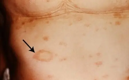 طرق إزالة البقع البنية من الجسم