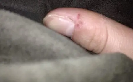 أسباب التهاب الجلد حول الأظافر