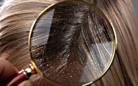 علاج قشرة الشعر الجاف