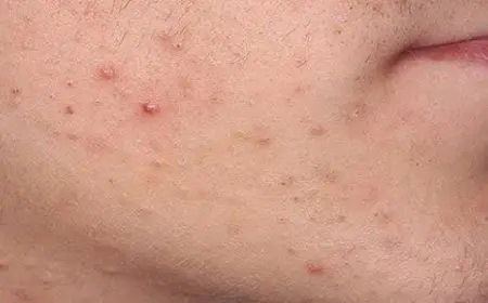 أسباب الحبوب الحمراء في الوجه