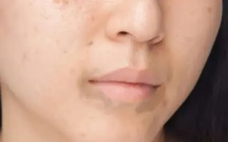 أفضل كريم لعلاج الاسمرار حول الفم