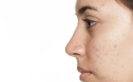 سبب ظهور حبوب في الوجه فجأة