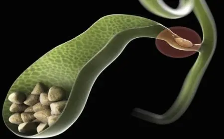 تجربتي في تفتيت حصوة المرارة