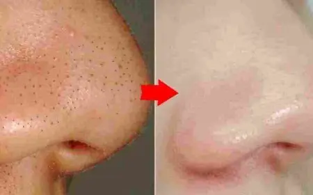 كيف أزيل الرؤوس السوداء