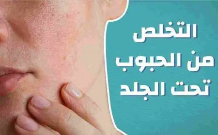 كريم للحبوب تحت الجلد