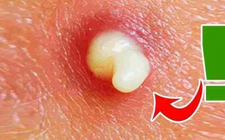 علاج الهالات السوداء