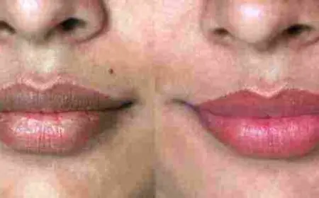 ازالة سواد الشفايف نهائيا