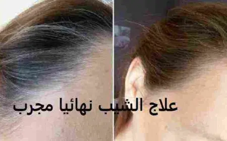 ازالة الشعر بالليزر ما هي أهميته