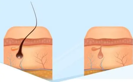 أفضل بنج موضعي للمنطقة الحساسة قبل الليزر