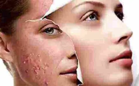 كيفية التخلص من حب الشباب