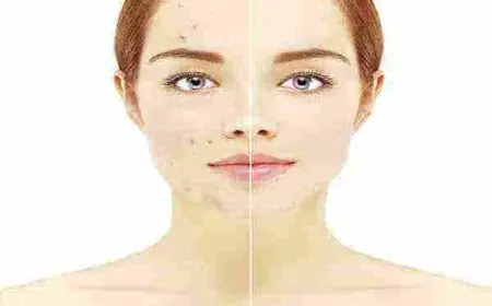 أفضل غسول طبي للبشرة الدهنية وحب الشباب