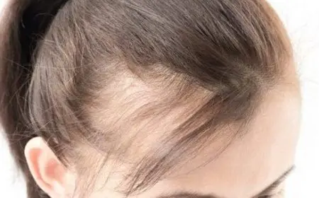 أفضل علاج لتساقط الشعر