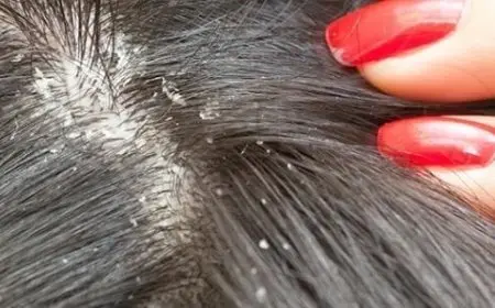 التخلص من القمل في يوم واحد