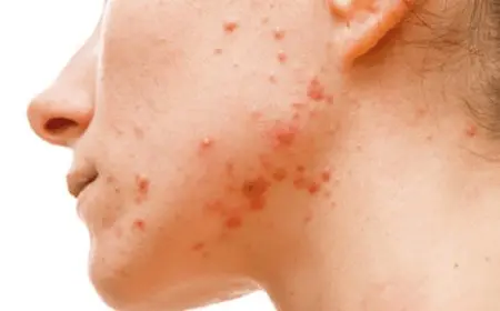 أنواع حبوب الوجه بالصور