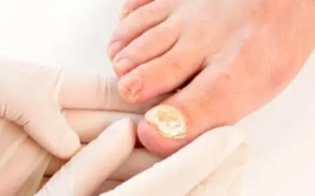 علاج فطريات الأظافر بالخل