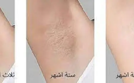 جدول جلسات الليزر المنزلي