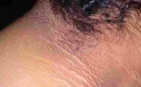 تقشير الرقبة من السواد