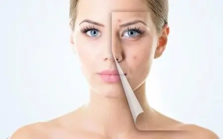 أفضل كريم لعلاج الحبوب الدهنية تحت الجلد في الصيدليات