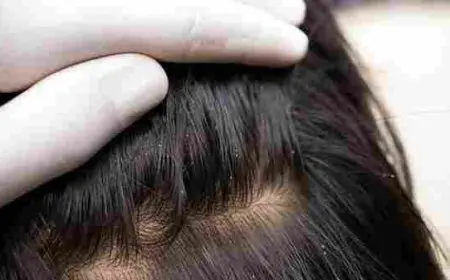 التخلص من بيض القمل بالفازلين