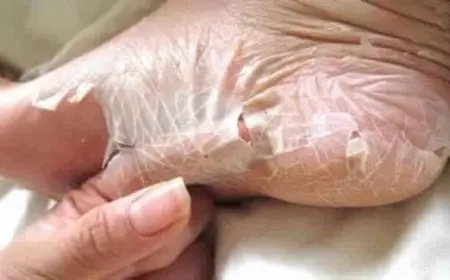 ظهور الشعر بعد الليزر بيومين