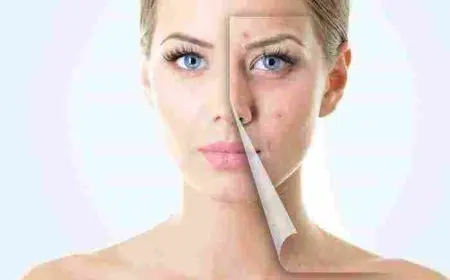 وصفة لإزالة الحبوب من الوجه في يوم واحد