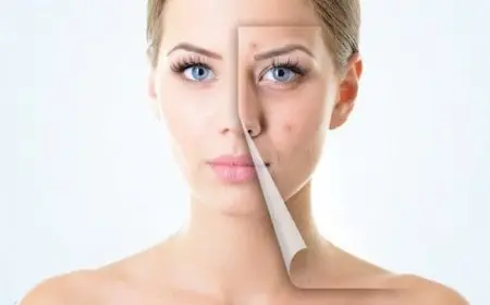 علاج حب الشباب عند البنات بطرق مختلفة وفعالة