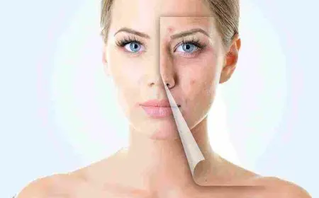 وصفة لازالة حب الشباب من اول مرة