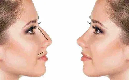 تجربتي مع عملية تجميل الأنف