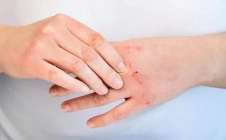علاج تشقق اليدين من الغسيل