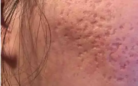 تجربتي مع قطع الندبات