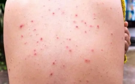 أسباب ظهور حبوب في الظهر فجأة وطريقة علاجها في المنزل بالأعشاب الطبيعية