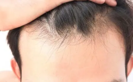 أسباب تساقط الشعر عند الشباب وعلاجه