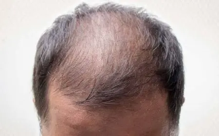 تجربتي مع الخلايا الجذعية للشعر