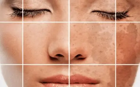 علاج التصبغات البنية في الوجه