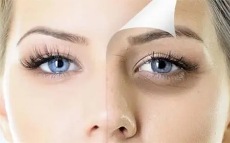 8 وصفات لعلاج الهالات السوداء حول العين نهائيًا بطريقة سريعة