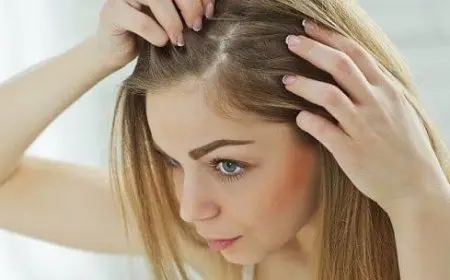 ما هو أفضل علاج لقشرة الشعر.. و5 وصفات طبيعية لعلاجه