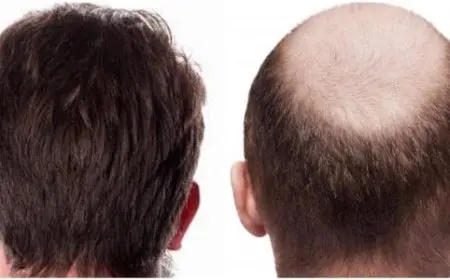 تجربتي مع زراعة الشعر