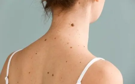 الفرق بين الشامة وحبة الخال