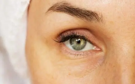 تجربتي مع حقن الفيلر تحت العين