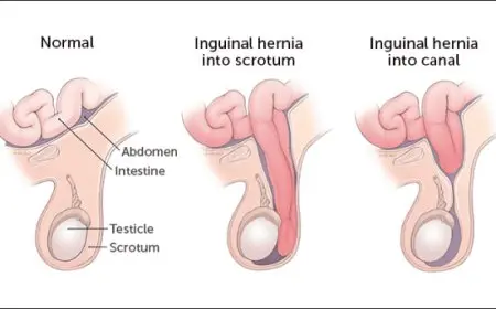 اعراض الفتق الأربي عند الرضع